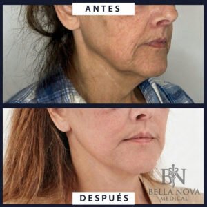 Antes y después facial