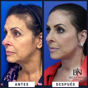 Antes y después facial